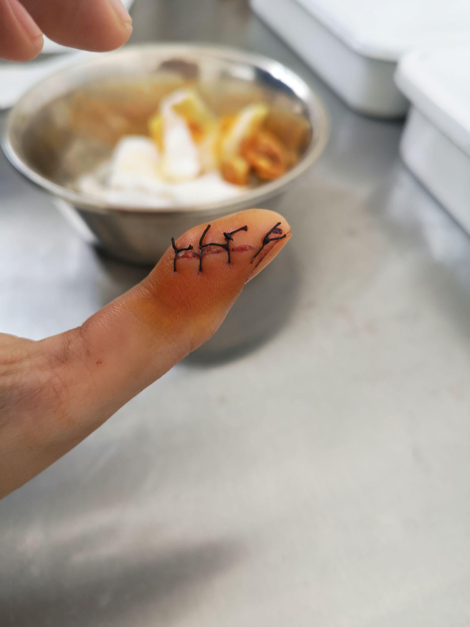 缝针和拆线可怕吗疼吗你们当时怕吗