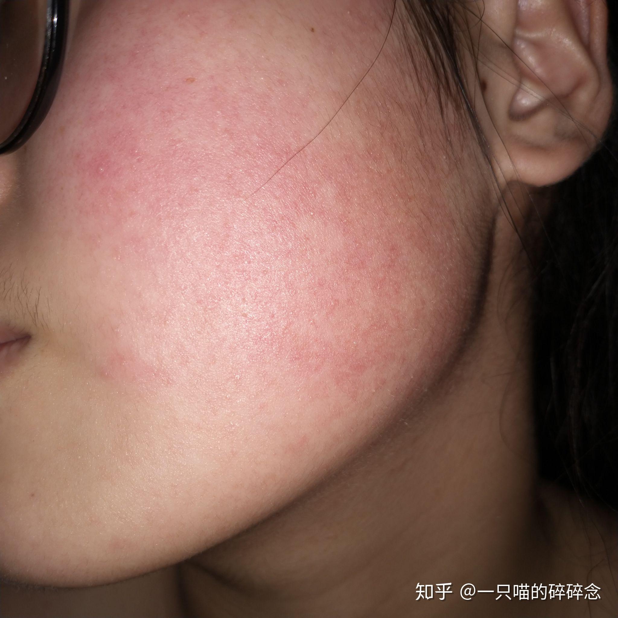 17岁脸颊两侧泛红有类似鸡皮疙瘩的小豆这是病吗是的话能治好吗