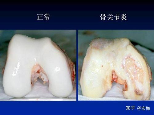 为什么关节软骨损伤后不能修复? - 知乎