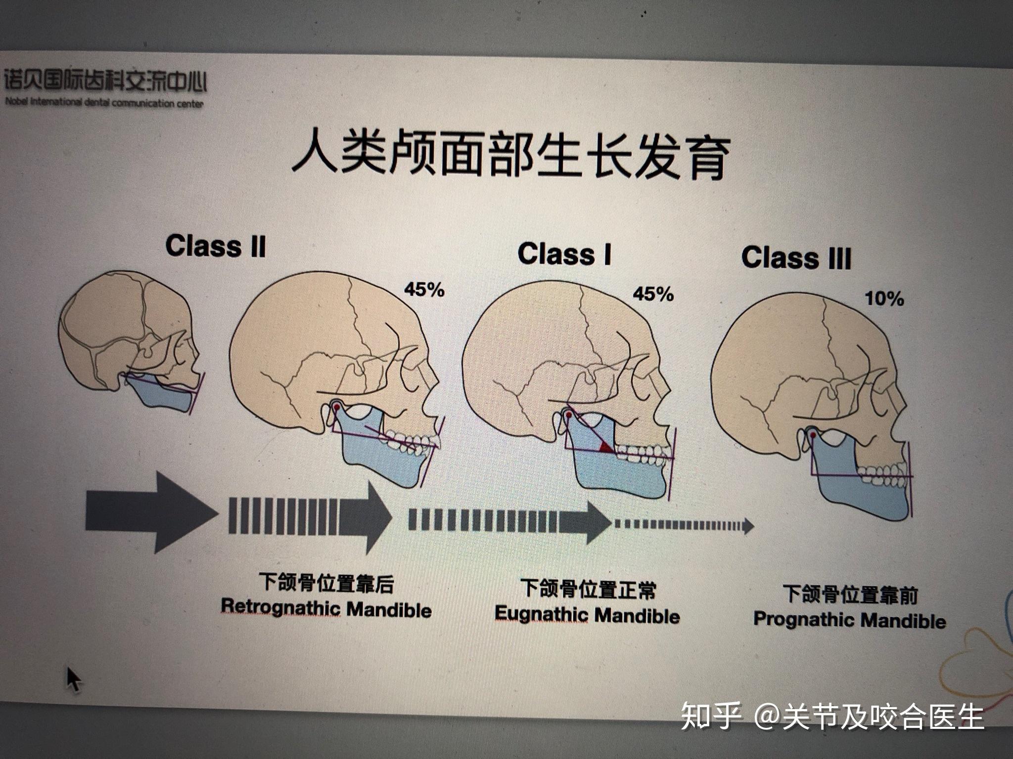 十岁女孩下颌发育不良后缩,该如何治疗? - 知乎