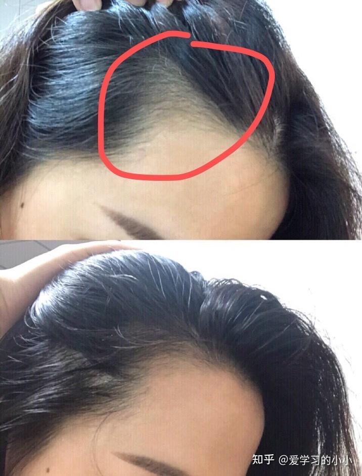 大家有颞侧头发稀疏的经历嘛不是前额和两侧是耳朵上方