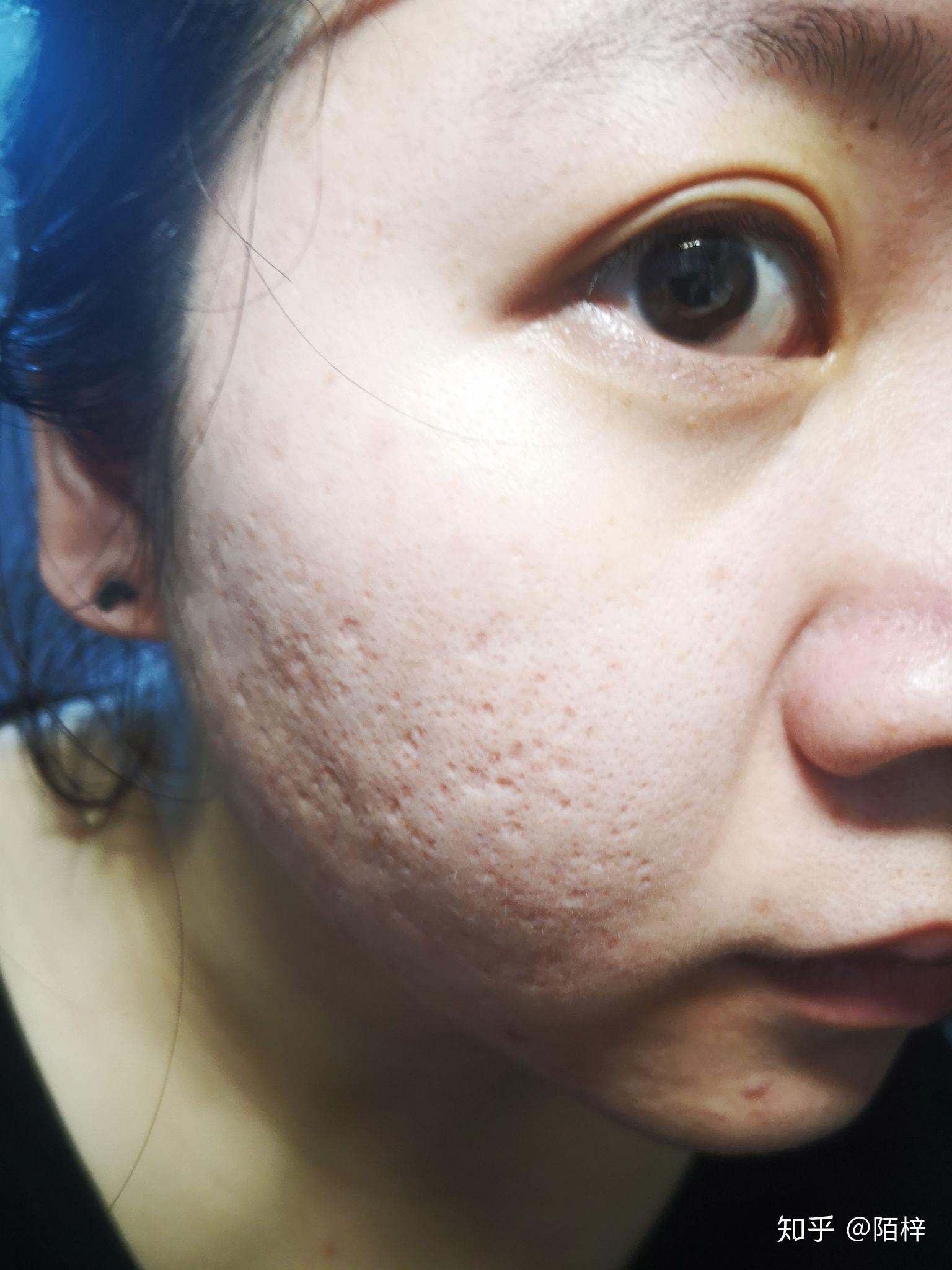 满脸痘坑的人都活得怎么样