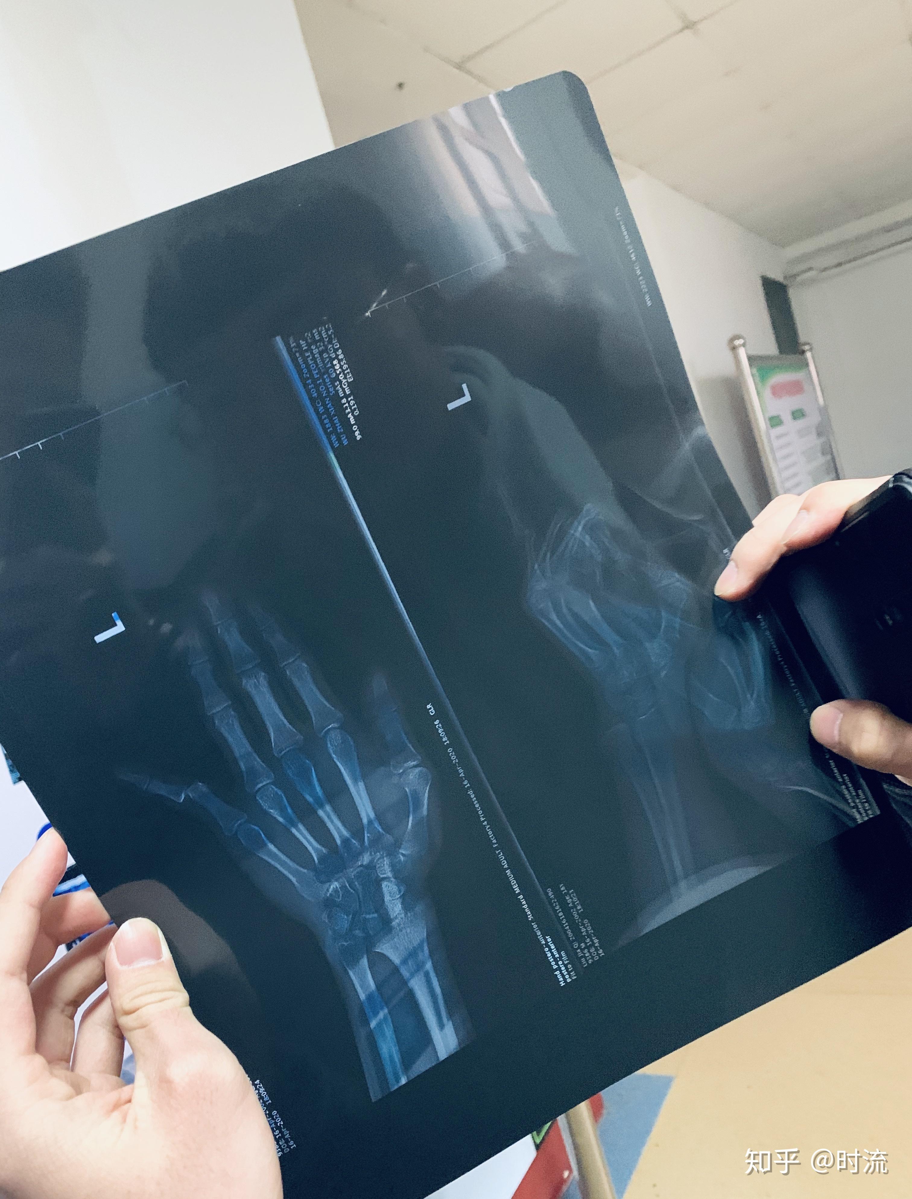 左手大拇指因为打球挫伤,感觉错位了,可以通过什么方法恢复? - 知乎