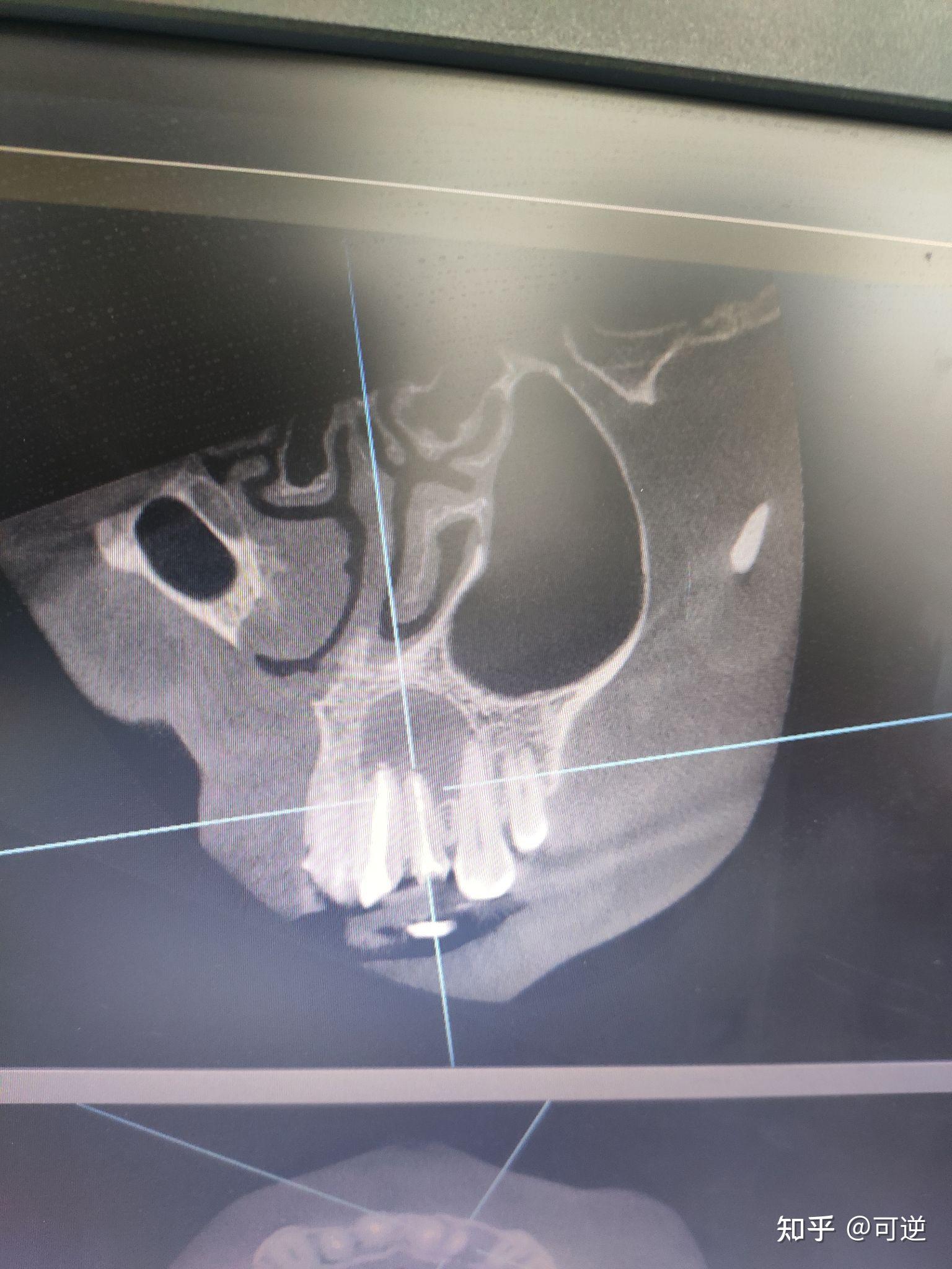 牙龈囊肿可以不做手术吗 时间久了有什么危害? - 知乎