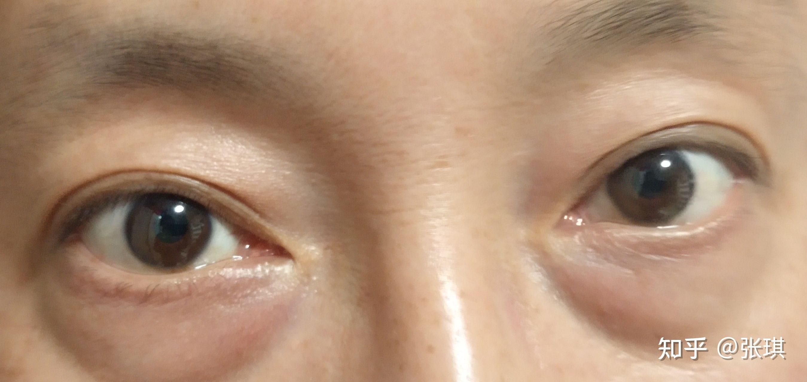 什么是蒙古褶? - 知乎