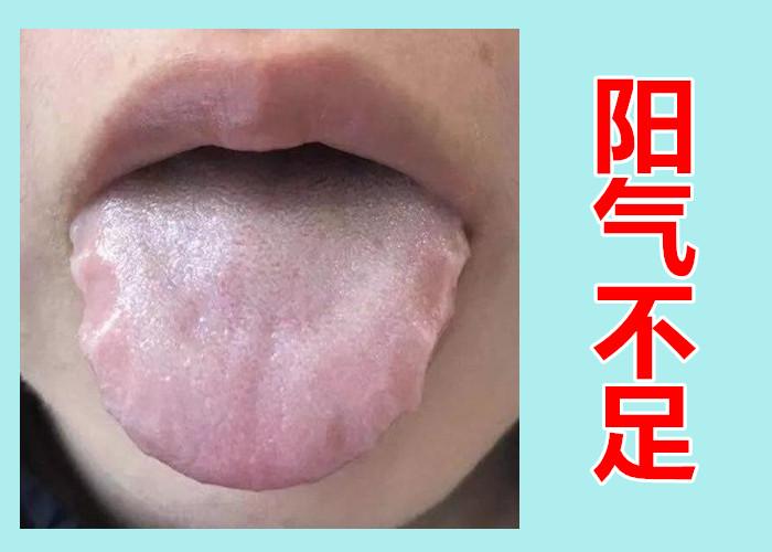阳气不足舌先知！快来对照自己的舌头，看看自己阳虚到了哪一级？ - 知乎