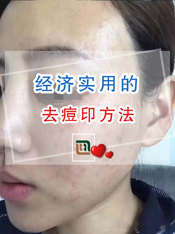 经济实用的去痘印方法 - 知乎