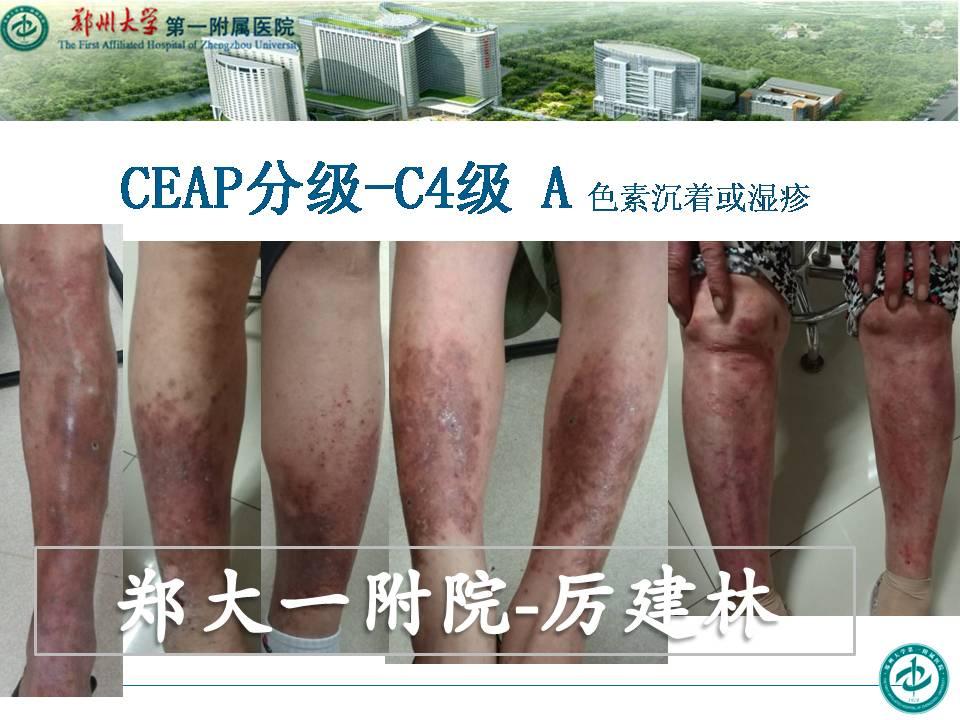 下肢静脉曲张CEAP分级 - 知乎