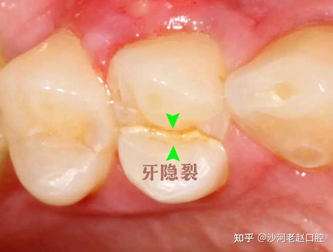 牙齿为什么有裂缝? - 知乎