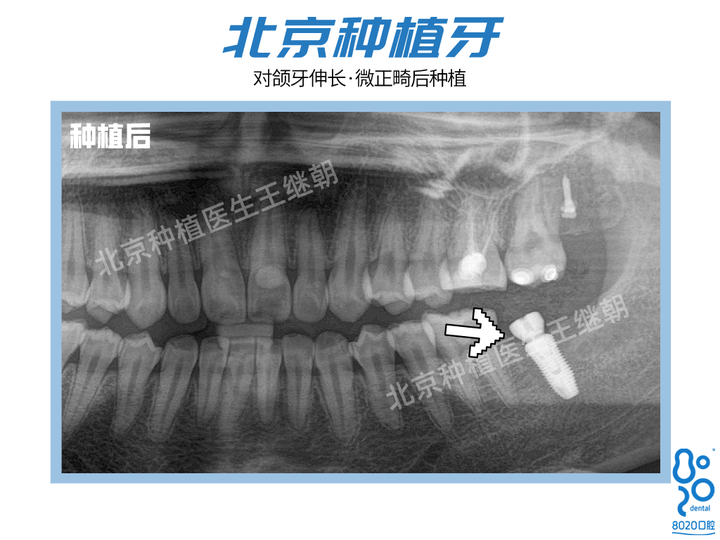 北京种植牙案例|缺牙太久有什么危害？想种牙时发现对颌牙伸长，建议先正畸再种植 - 知乎