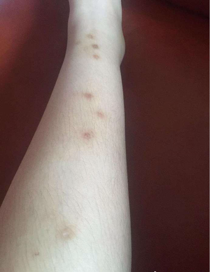 夏天被蚊虫叮咬后会留下疤痕吗