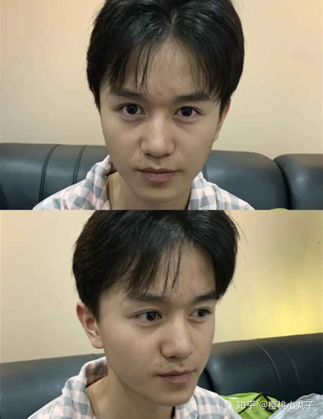 男生隆鼻前后样貌和生活状态对比