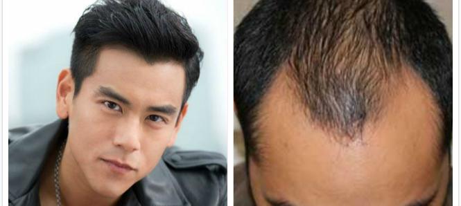 健康m型发际线早晚会秃彭于晏古天乐都是m型发际线