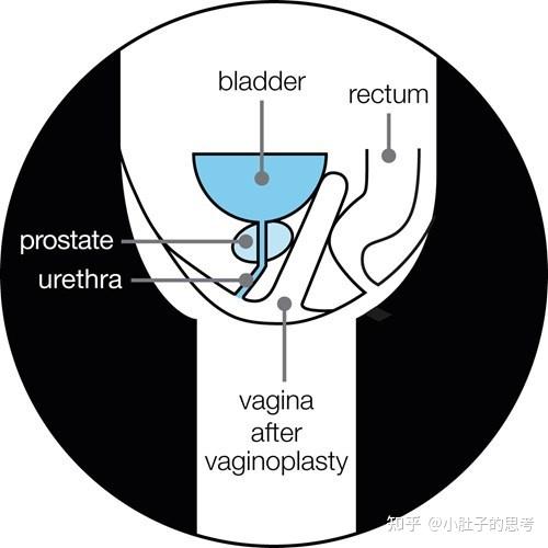 变性手术男变女要切除前列腺吗?