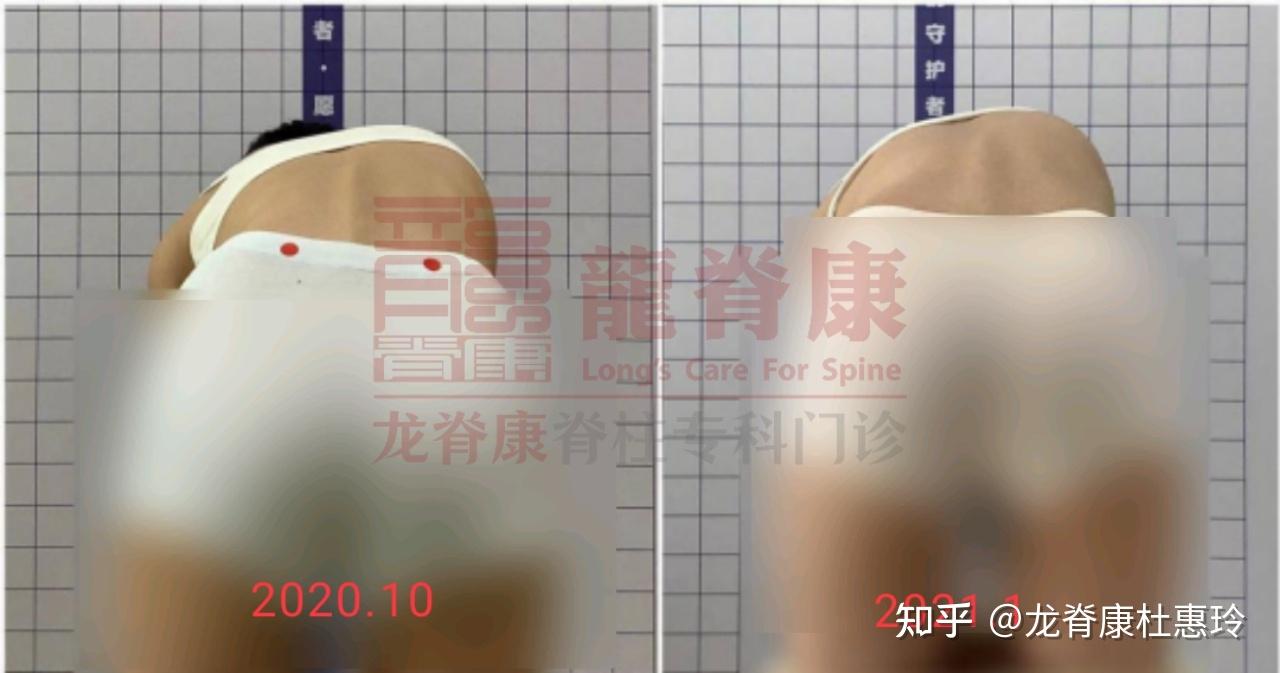 超过30度的脊柱侧弯怎么改善