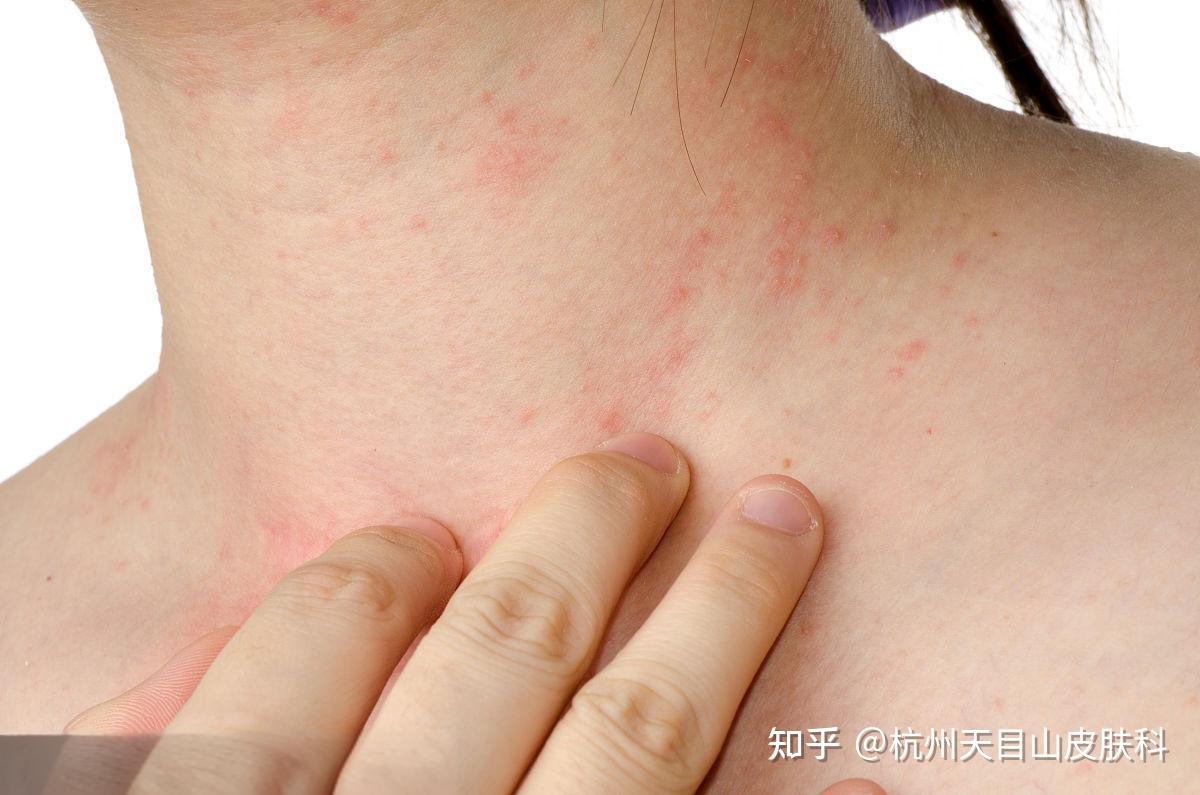 脖子上突发红疹瘙痒?专家揭秘常见病因及应对策略 - 知乎