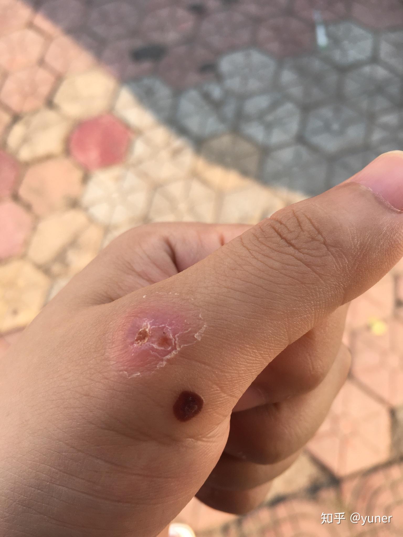 治疗手指上的寻常疣鱼鳞痣有什么办法或者药物