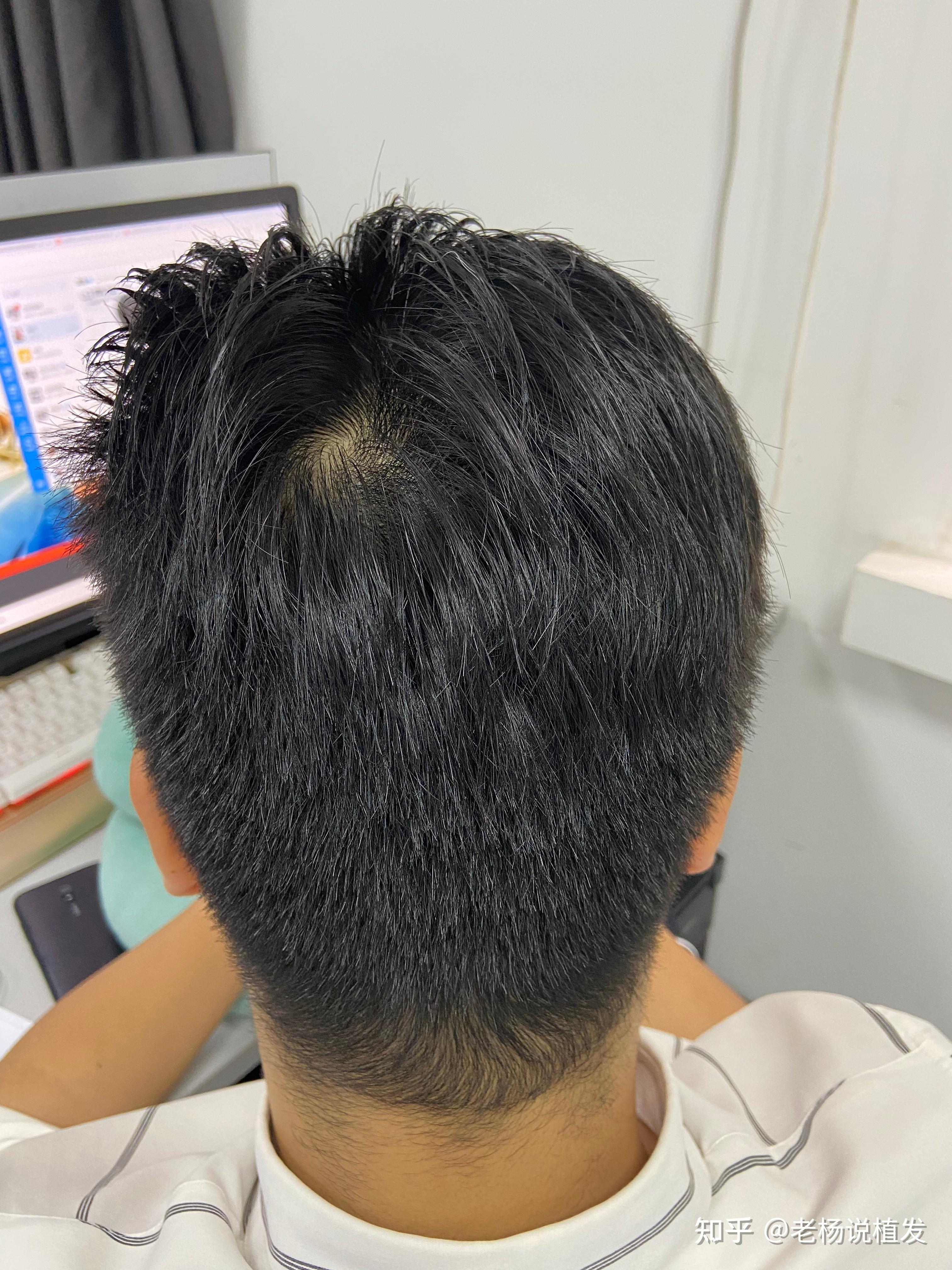 16岁,高一,为什么头顶旋处掉发啊? - 知乎