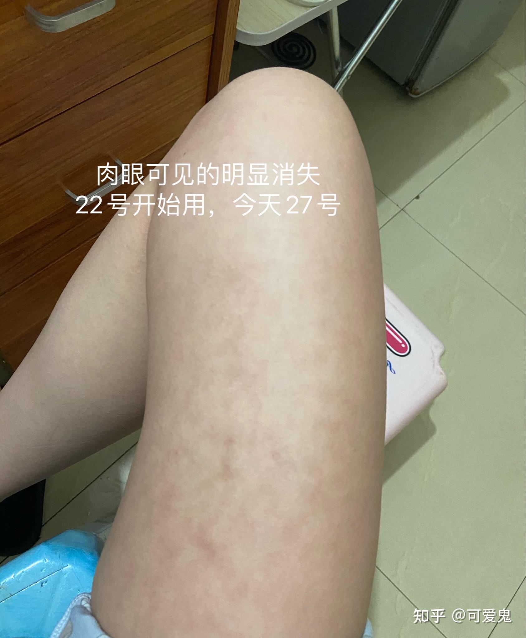 电暖风烫伤腿上起了一片像大理石纹一样的斑纹哪位同学有过同样经历