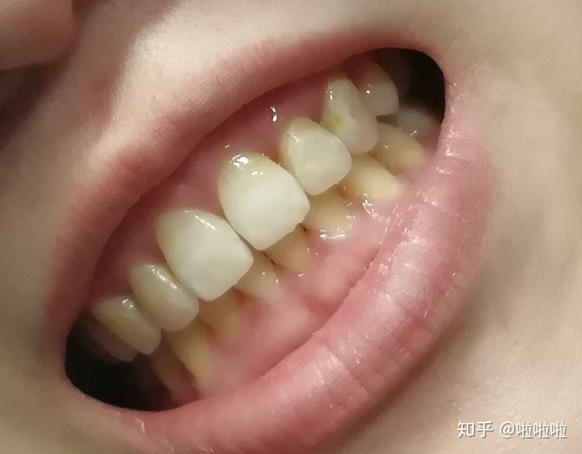 牙齿脱矿记录 - 知乎