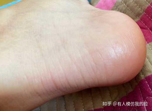 脚底发硬该如何改善