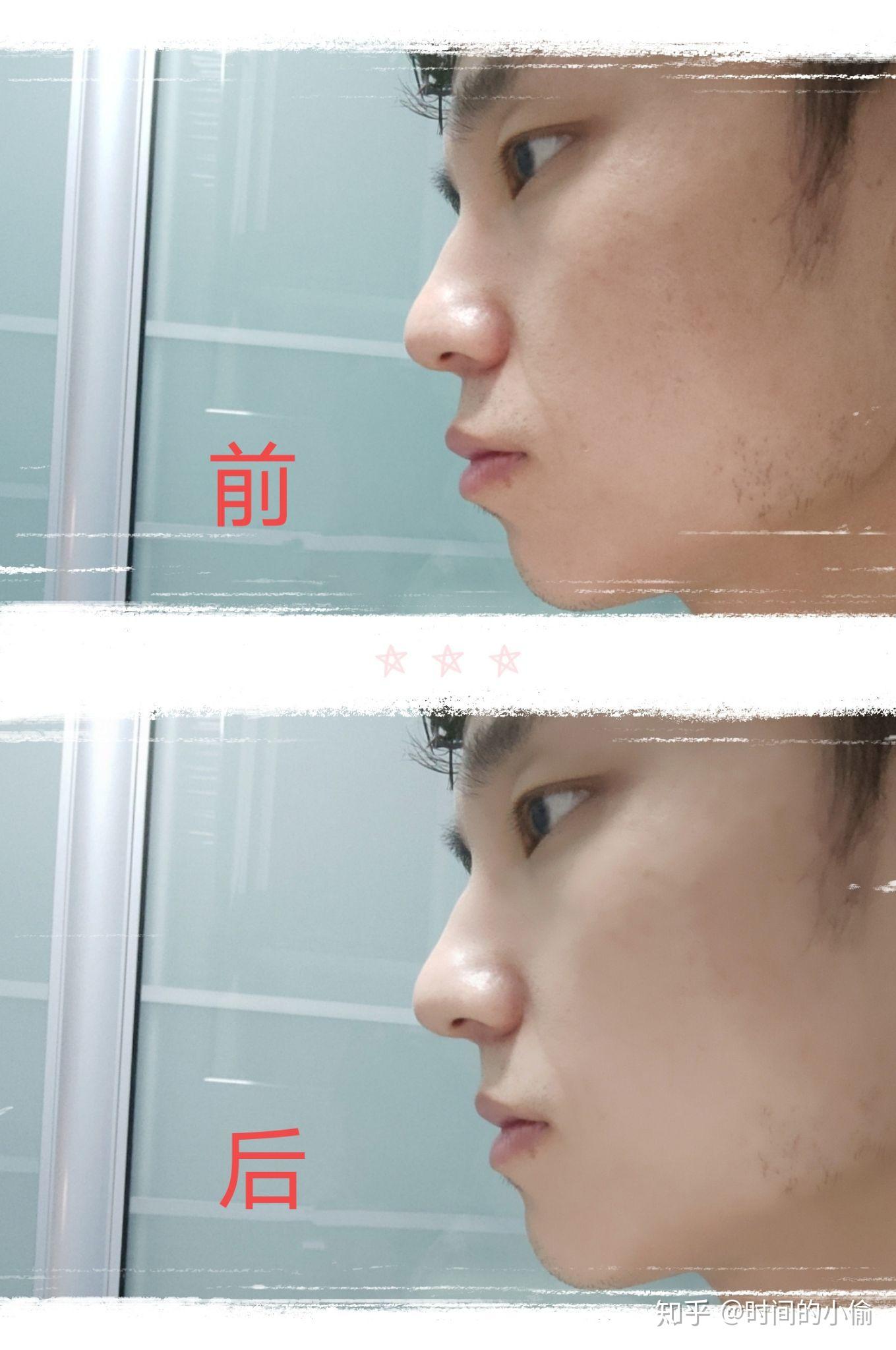 请问大家,仅门牙外凸(轻微外翻),下牙十分整齐,上下牙咬合关系很好,有