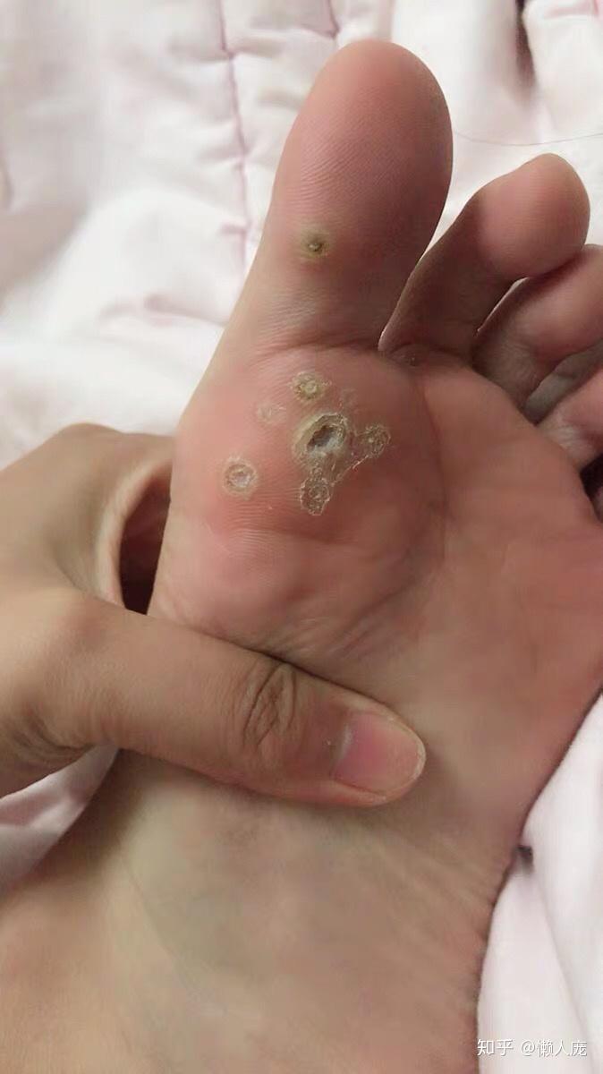 脚上感染长了疣怎么弄