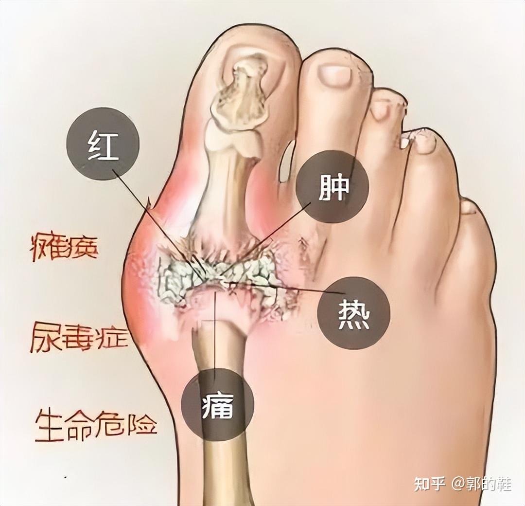 跑步后脚痛是怎么回事