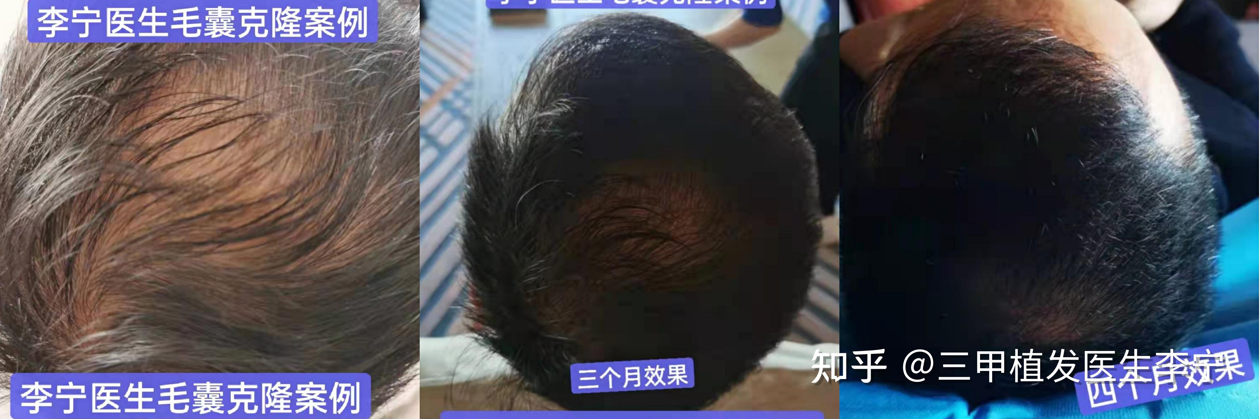头发易掉的原因有哪些？毛囊干细胞生发技术让你毛发再生！ - 知乎