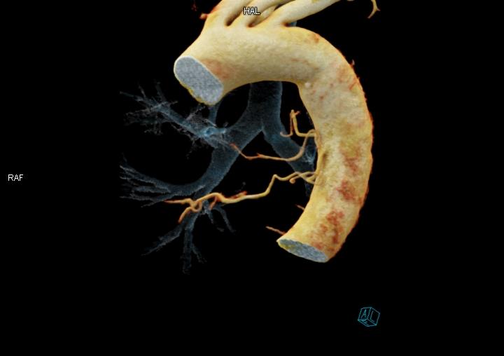 支气管动脉cta成像技术