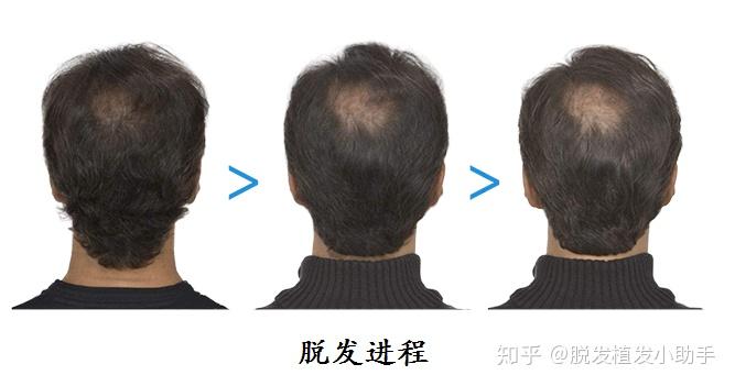 女生头顶后有发旋,头发遮不住,直接暴露出来,丑爆