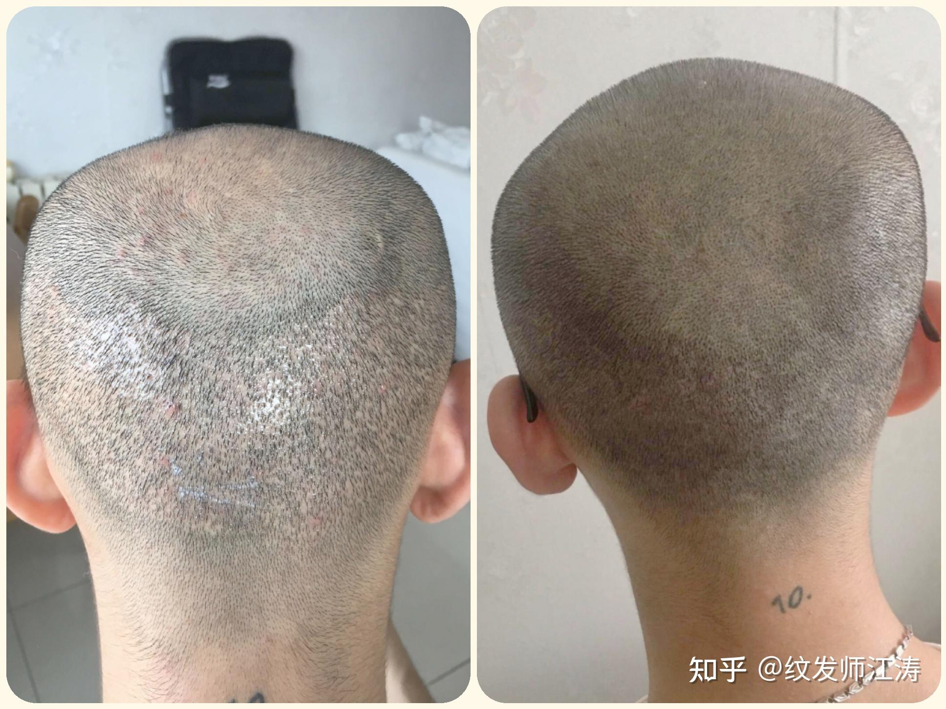 精锐植发西安(西安植发医院推荐)