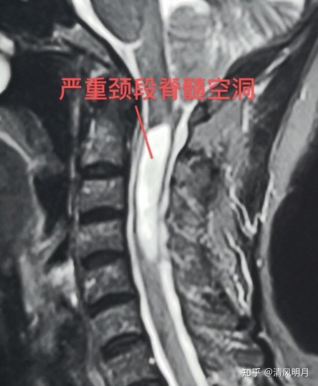 脊髓空洞病图片