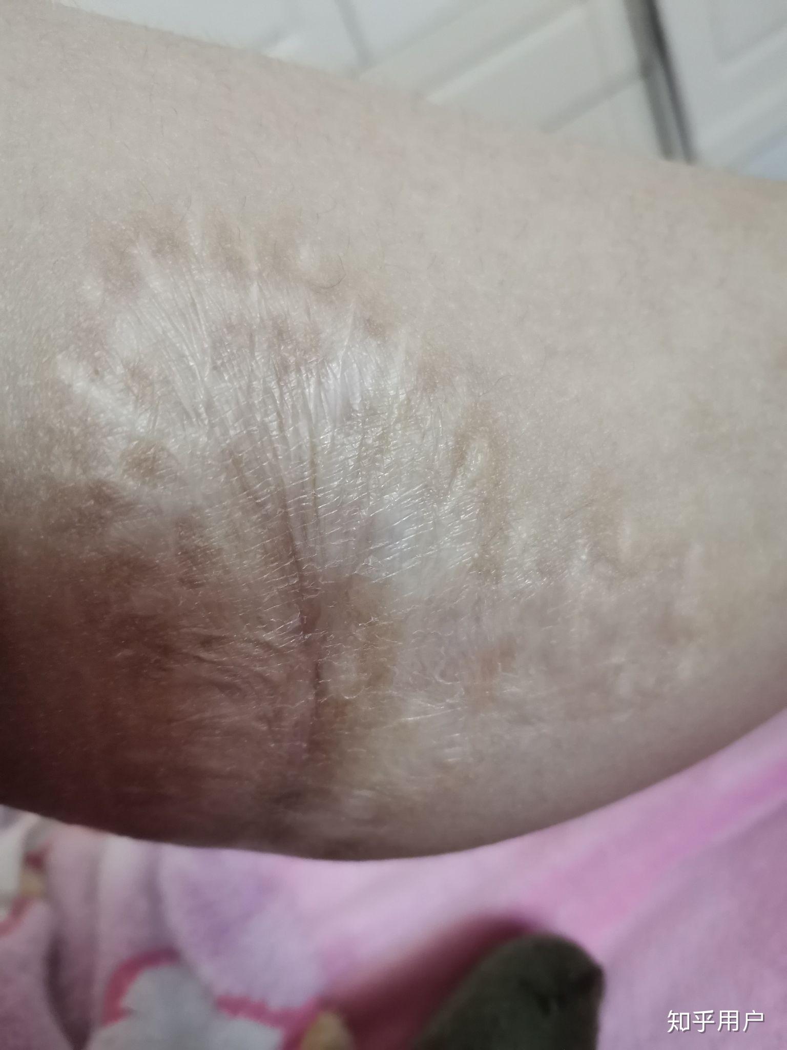 有没有人因腿上有大面积疤十几年都没穿过短裤短裙