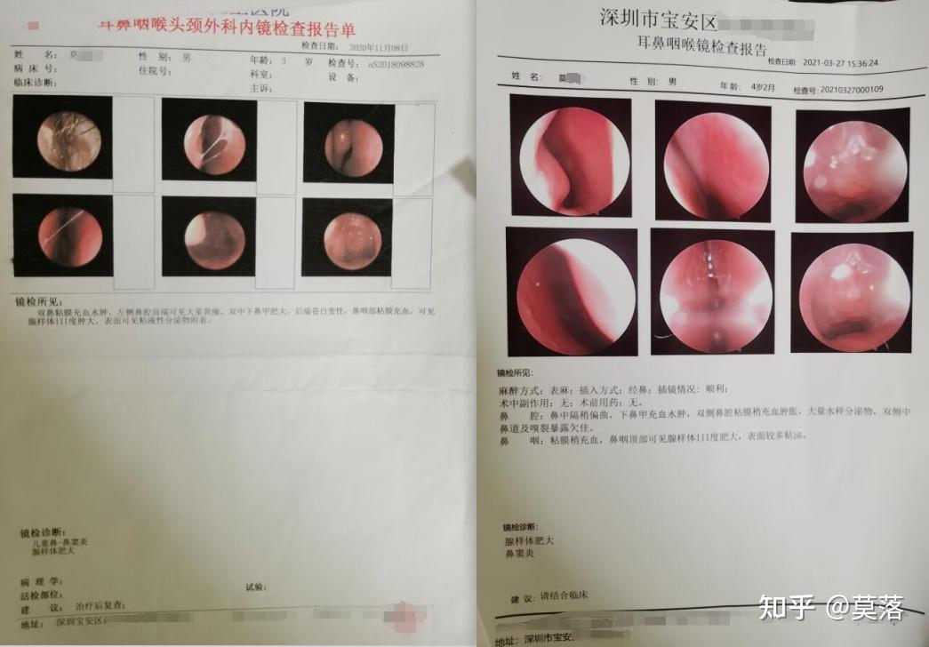 小孩4岁腺样体肿大做鼻内镜低温等离子消融手术容易复发吗