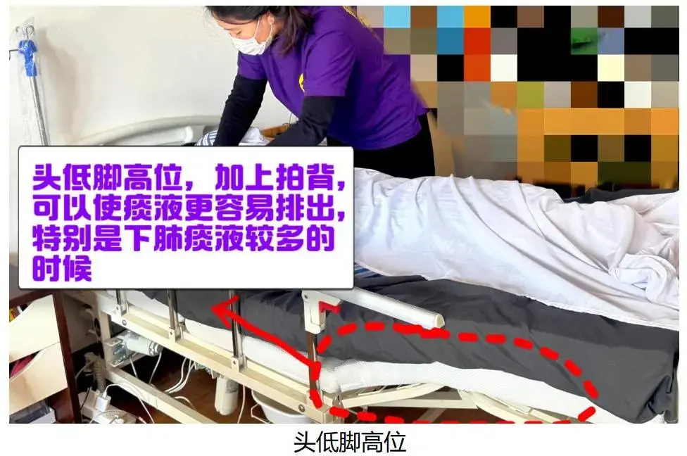 图文演示：协助排痰护理 - 知乎
