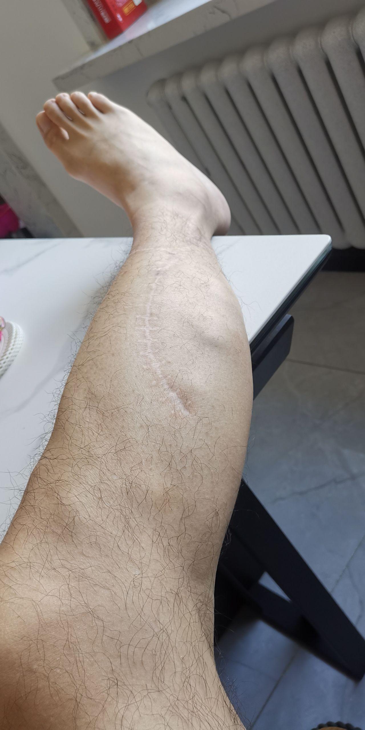 有没有人有小腿肌疝?怎么感觉这个病没法子治?