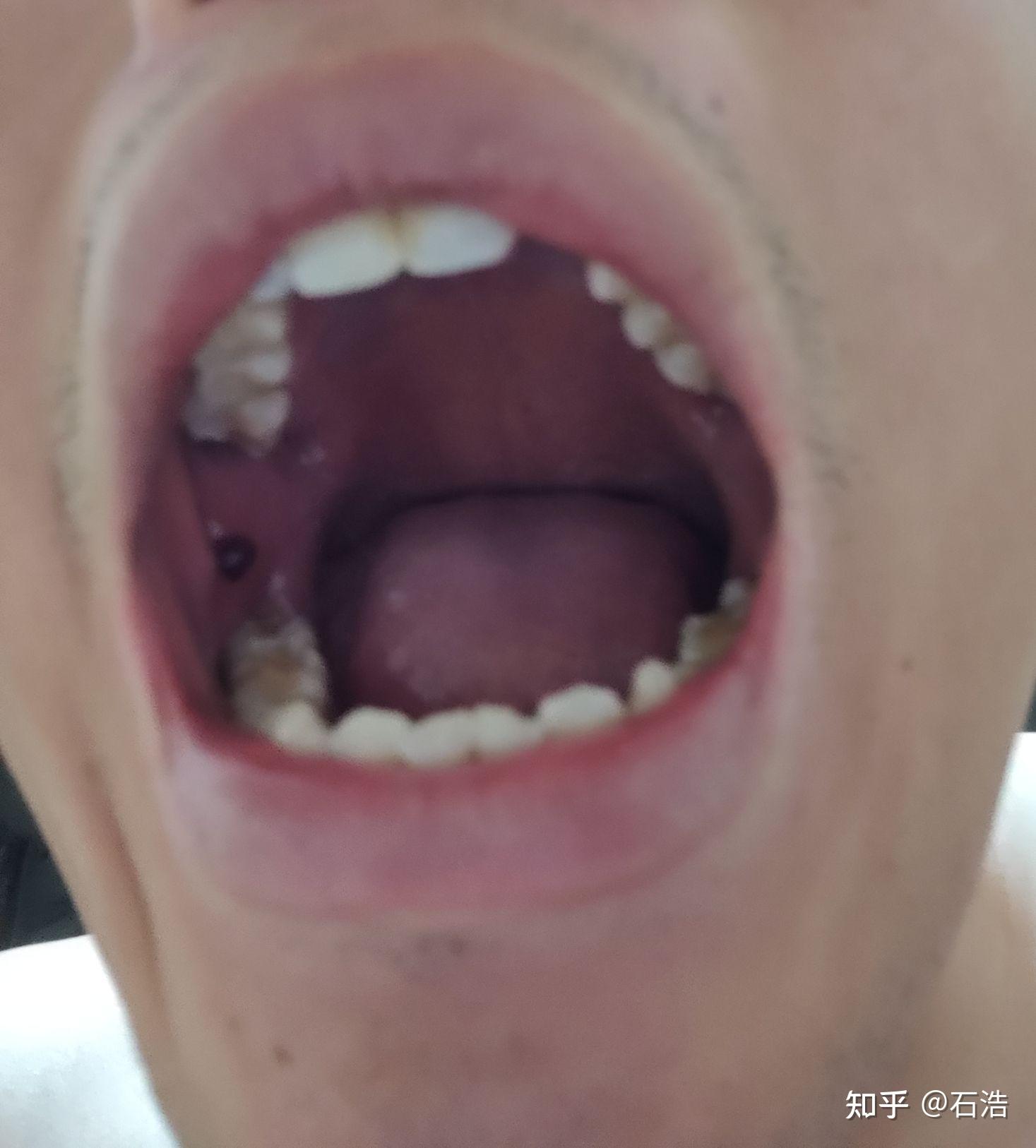 嘴巴里面腮处起了个黑色血泡是怎么回事? - 知乎