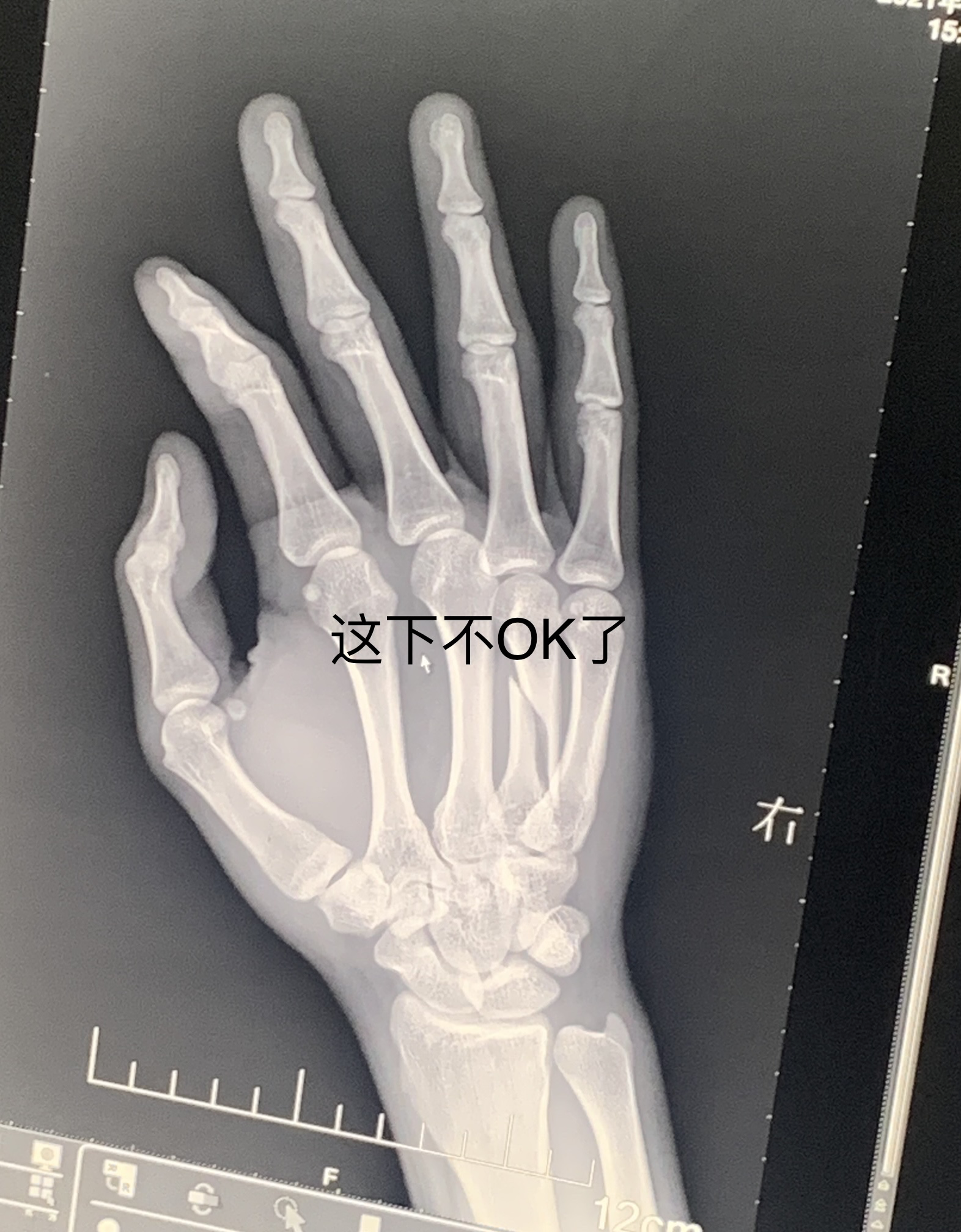 右手第四掌骨骨折保守治疗的第16天,恢复的是否不太理想? - 知乎