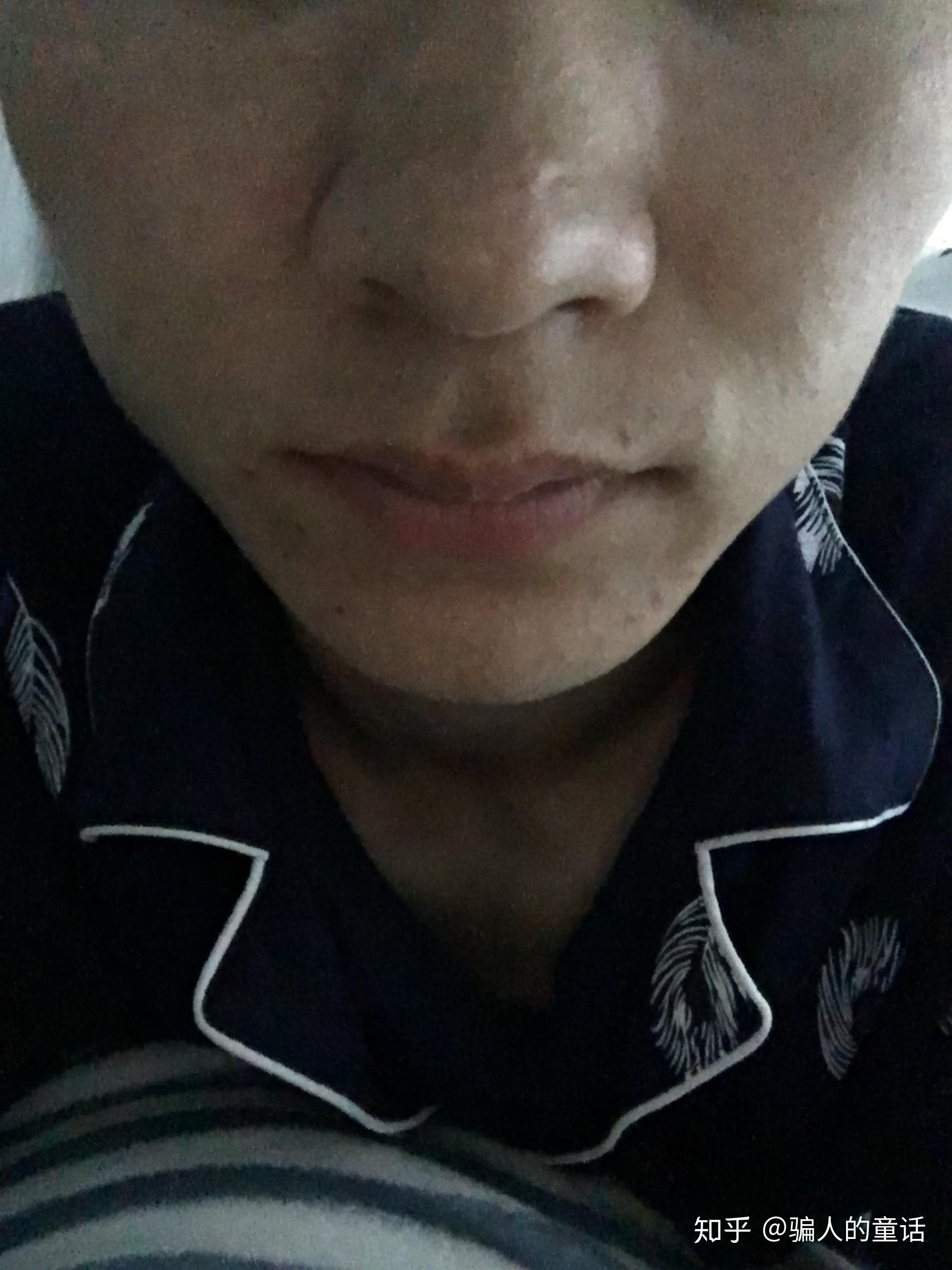 下巴和脖子交界处总长痘痘是什么原因,该怎么办? - 知乎
