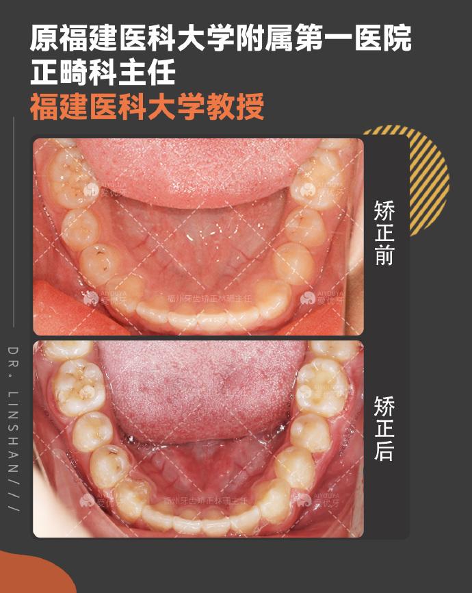你的反颌(地包天)正畸矫正成功了吗? - 知乎