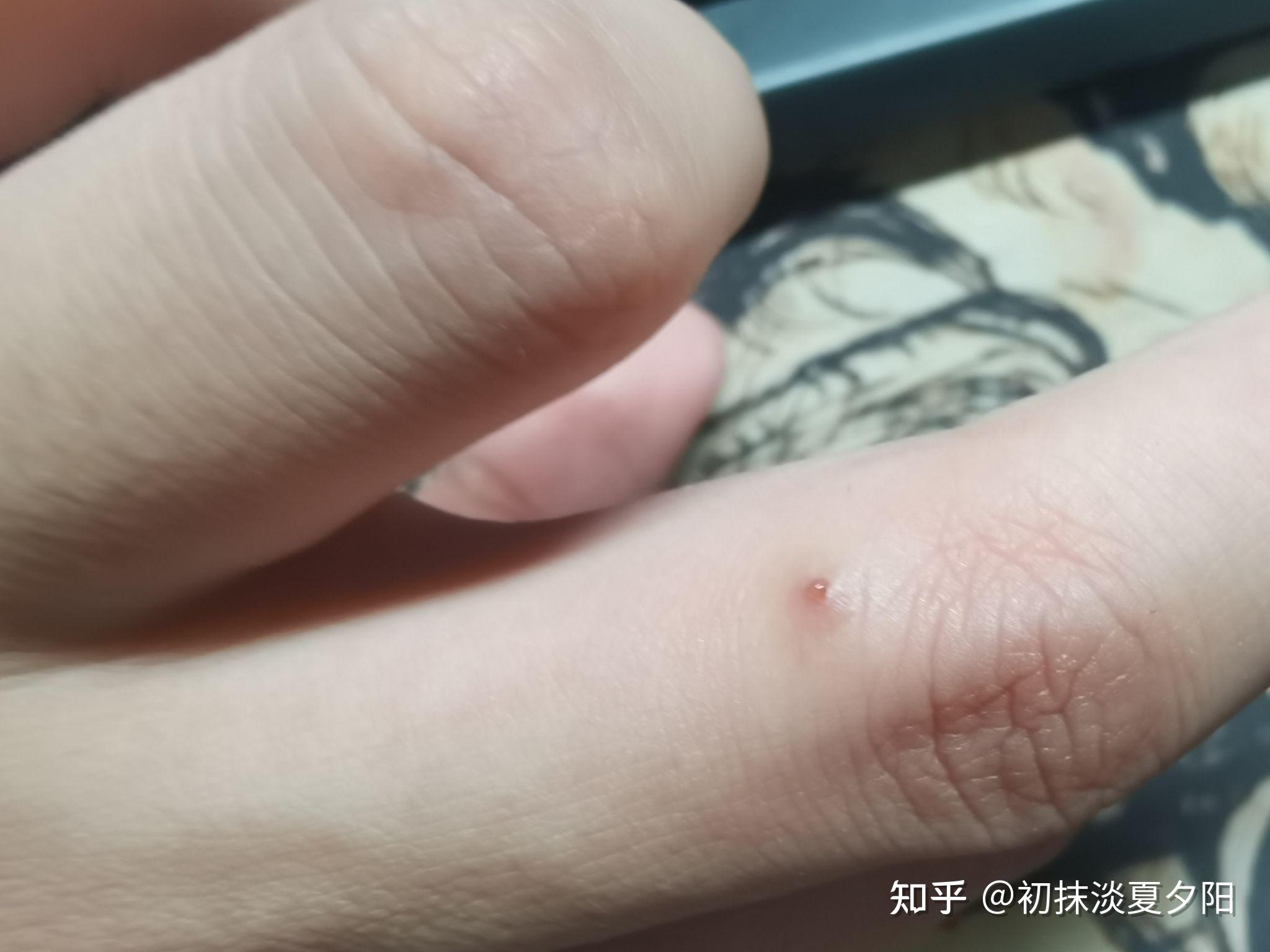 不知道被什么虫子咬了一直有个小孔伤口四个月了一直没有愈合还特别痒