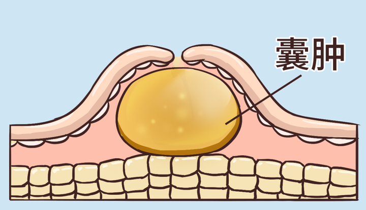 痰瘀互结百病生,教你一方,燥湿化痰 活血化瘀,体内痰瘀一网打尽 - 知乎