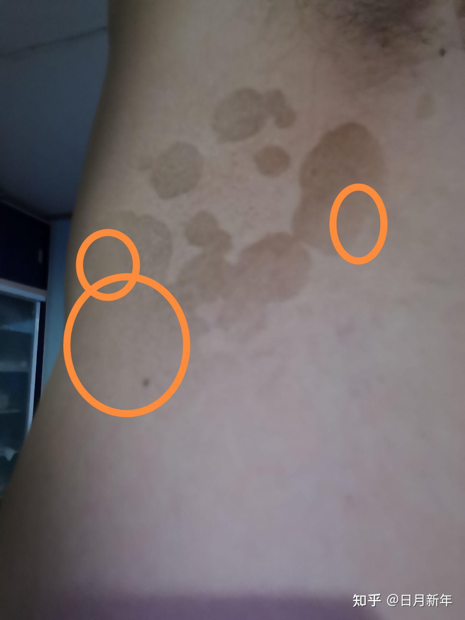 汗斑跟了我好几年了以前一直都是在后背现在蔓延到手臂上了大家推荐一