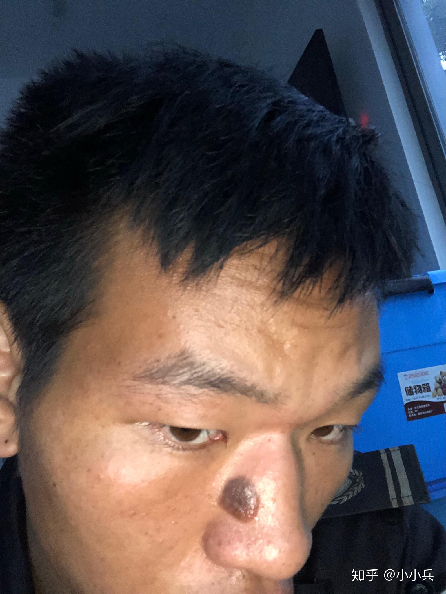 鼻子上有一个特大的黑色素痣,能做掉吗? - 知乎