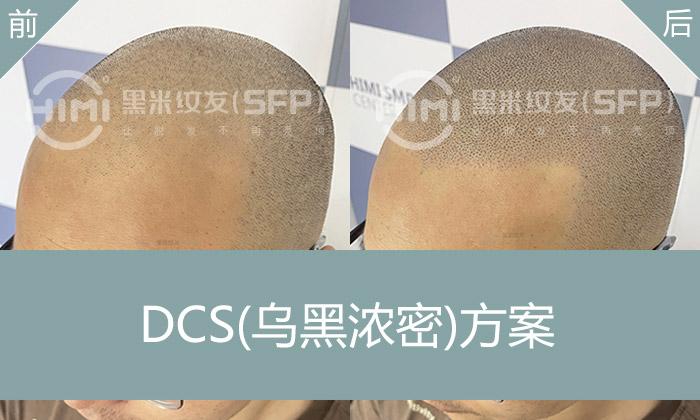 黑米纹发(SFP)案例：发际线后移又头顶稀疏？纹发变寸头帅哥 - 知乎