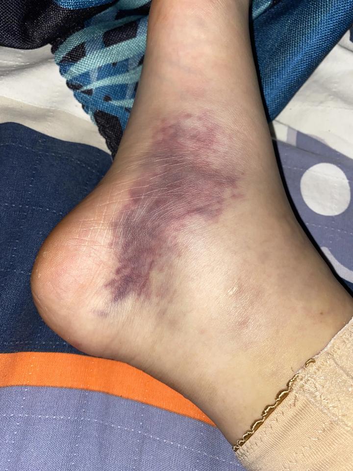 大腿抽脂的后遗症是什么?