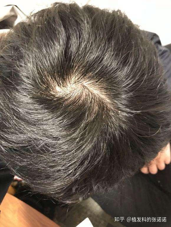 头旋头发稀少 我这是什么症状呢 大概一年前就这样了 没啥变化?
