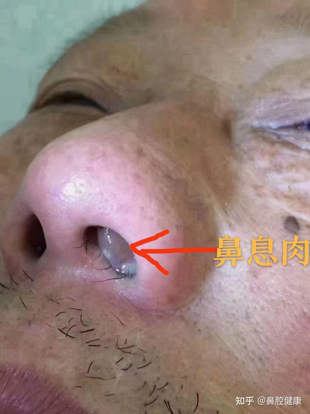 鼻息肉是如何形成的?