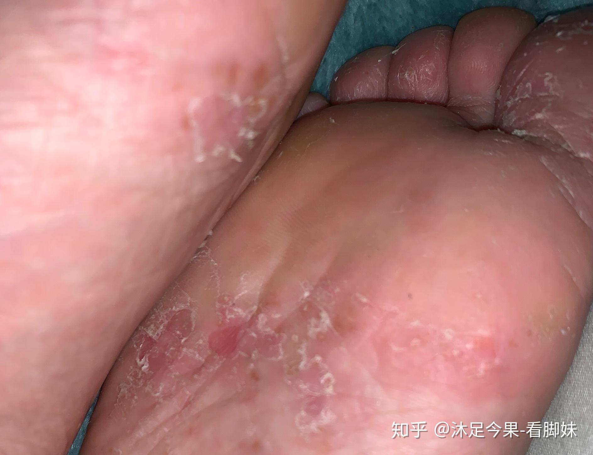 脚底长水泡抠出血了就像有虫子钻进去很痒很痒怎么回事怎么治急